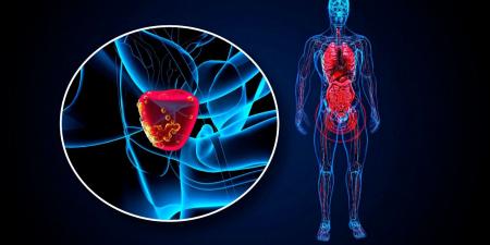 باحثون يبتكرون طريقة جديدة لعلاج سرطان البروستاتا العدواني - سعودي فايف